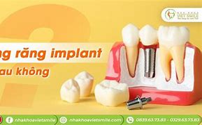 Trồng Răng Implant Có Đau Không